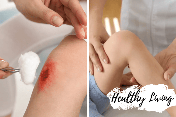 Honey for Wound Care: 11 Benefits  of Natural Treatment - Huckle Bee Farms LLC