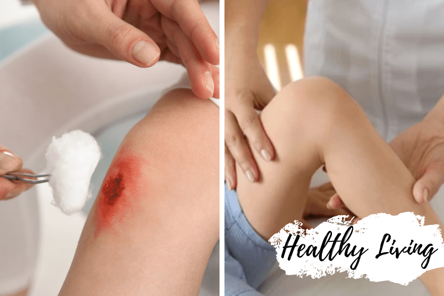 Honey for Wound Care: 11 Benefits  of Natural Treatment - Huckle Bee Farms LLC
